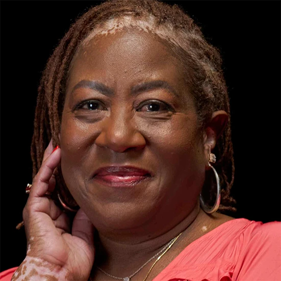 Vitiligo examples: A photo of a real patient smiling and showing off their skin after years of treatment for vitiligo with Opzelura.