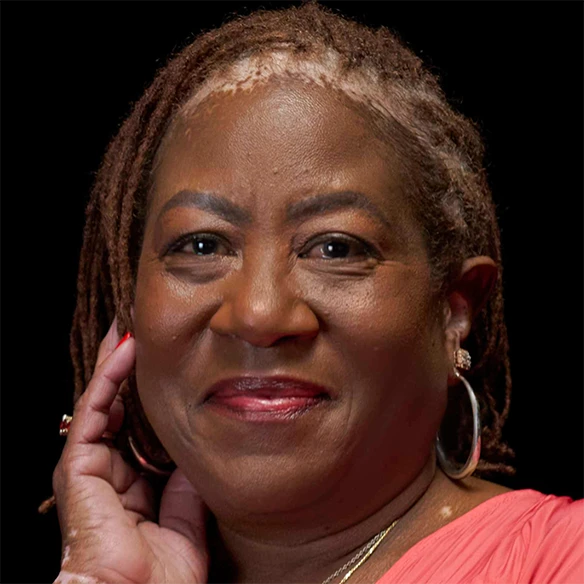 Vitiligo examples: A photo of a real patient smiling and showing off their skin after years of treatment for vitiligo with Opzelura.