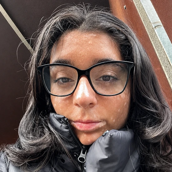 Vitiligo examples: A photo of a real patient after treatment for vitiligo with Opzelura on their face.