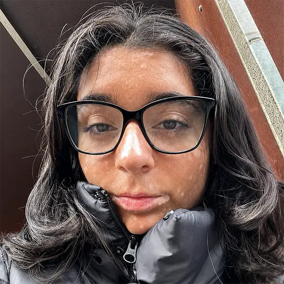 Vitiligo examples: A photo of a real patient after treatment for vitiligo with Opzelura on their face.