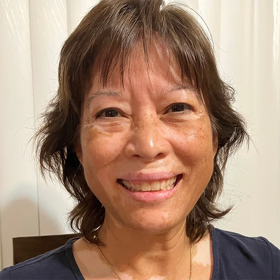 Vitiligo examples: A photo of a real patient after treatment for vitiligo with Opzelura on their face and chest.