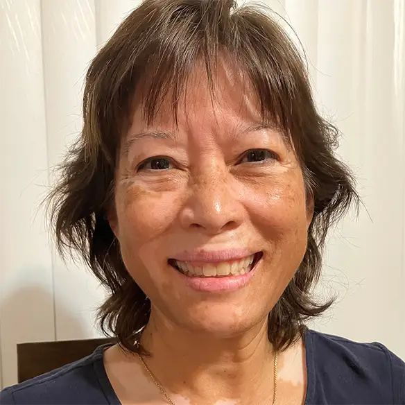 Vitiligo examples: A photo of a real patient after treatment for vitiligo with Opzelura on their face and chest.