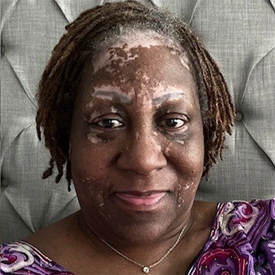 Vitiligo examples: A photo of a real patient before treatment for vitiligo with Opzelura on their face.