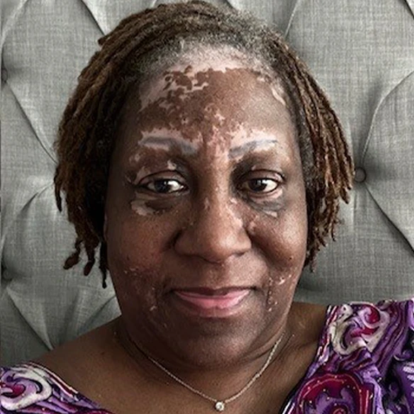 Vitiligo examples: A photo of a real patient before treatment for vitiligo with Opzelura on their face.