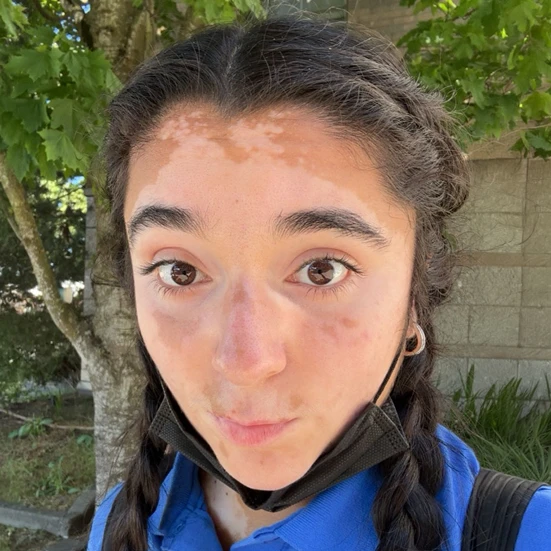 Vitiligo examples: A photo of a real patient before treatment for vitiligo with Opzelura on their face.