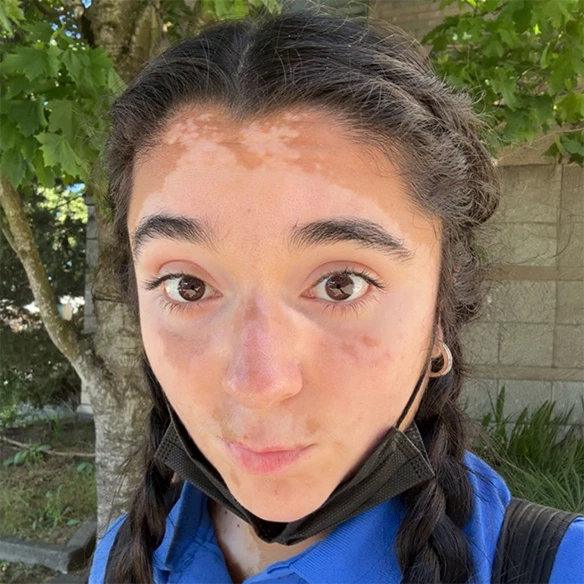 Vitiligo examples: A photo of a real patient before treatment for vitiligo with Opzelura on their face.