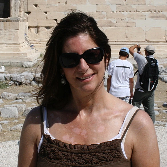 Vitiligo examples: A photo of a real patient before treatment for vitiligo with Opzelura on their neck and chest.