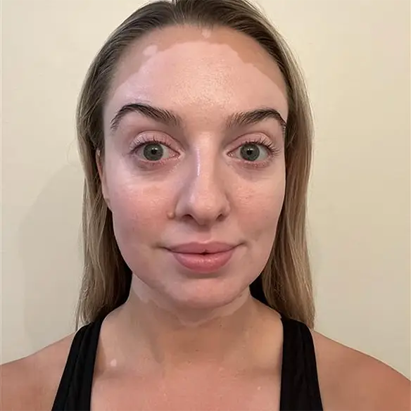 Vitiligo examples: A photo of a real patient before treatment for vitiligo with Opzelura on their face and chest.