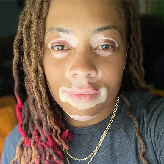 Vitiligo examples: A photo of a real patient before treatment for vitiligo with Opzelura on their face.