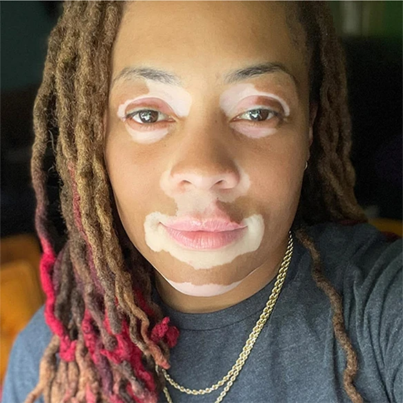 Vitiligo examples: A photo of a real patient before treatment for vitiligo with Opzelura on their face.